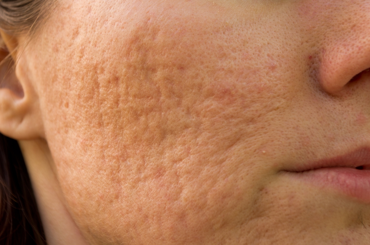 Jerawat Berlubang Bisa Hilang? Ini Cara Mengatasi Bekas Acne Scar