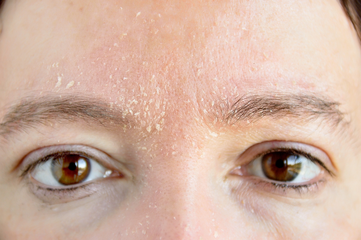 Kulit Kering atau Dehidrasi? Kenali Bedanya Biar Nggak Salah Pilih Skincare
