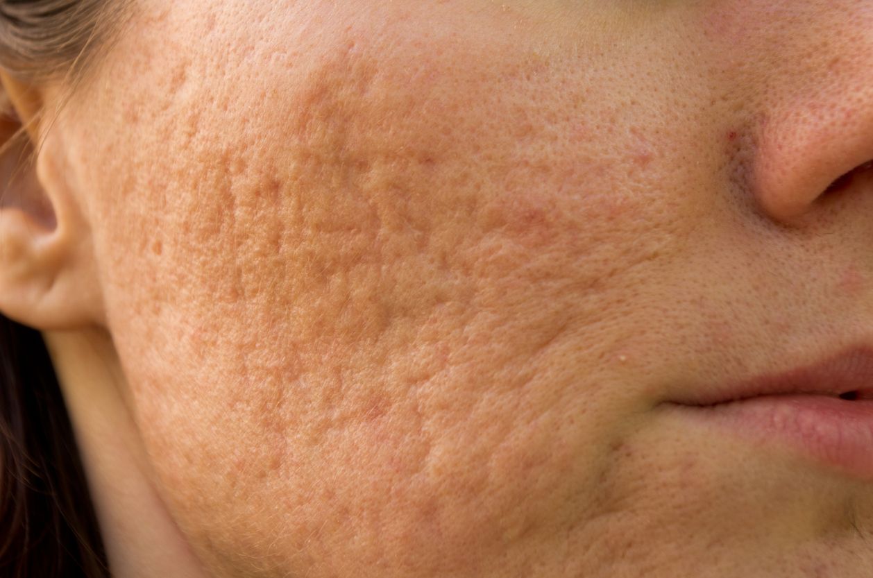 Jerawat Berlubang Bisa Hilang? Ini Cara Mengatasi Bekas Acne Scar