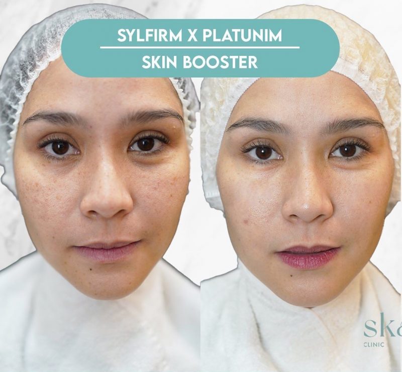 Skin Booster Skaer Clinic
