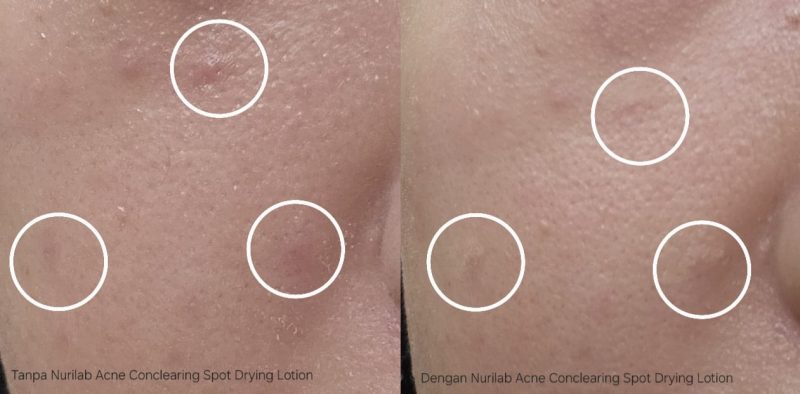 rekomendasi conceler untuk menutupi jerawat