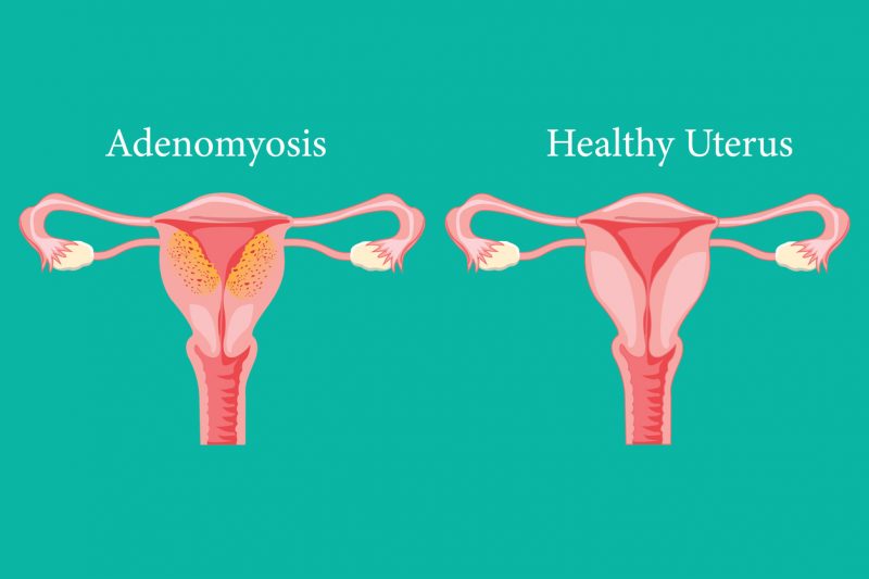 adenomiosis