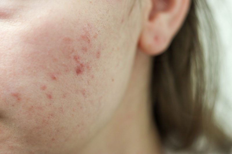 bekas jerawat kemerahan (PIE)