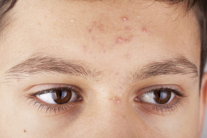 azelaic acid untuk jerawat