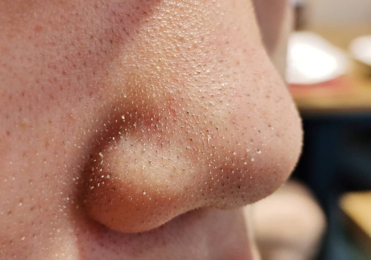 whiteheads di hidung